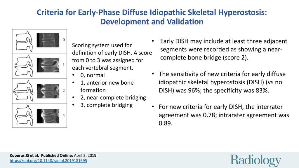 Criteria for Early-Phase Diffuse Idiopathic Skeletal Hyperostosis