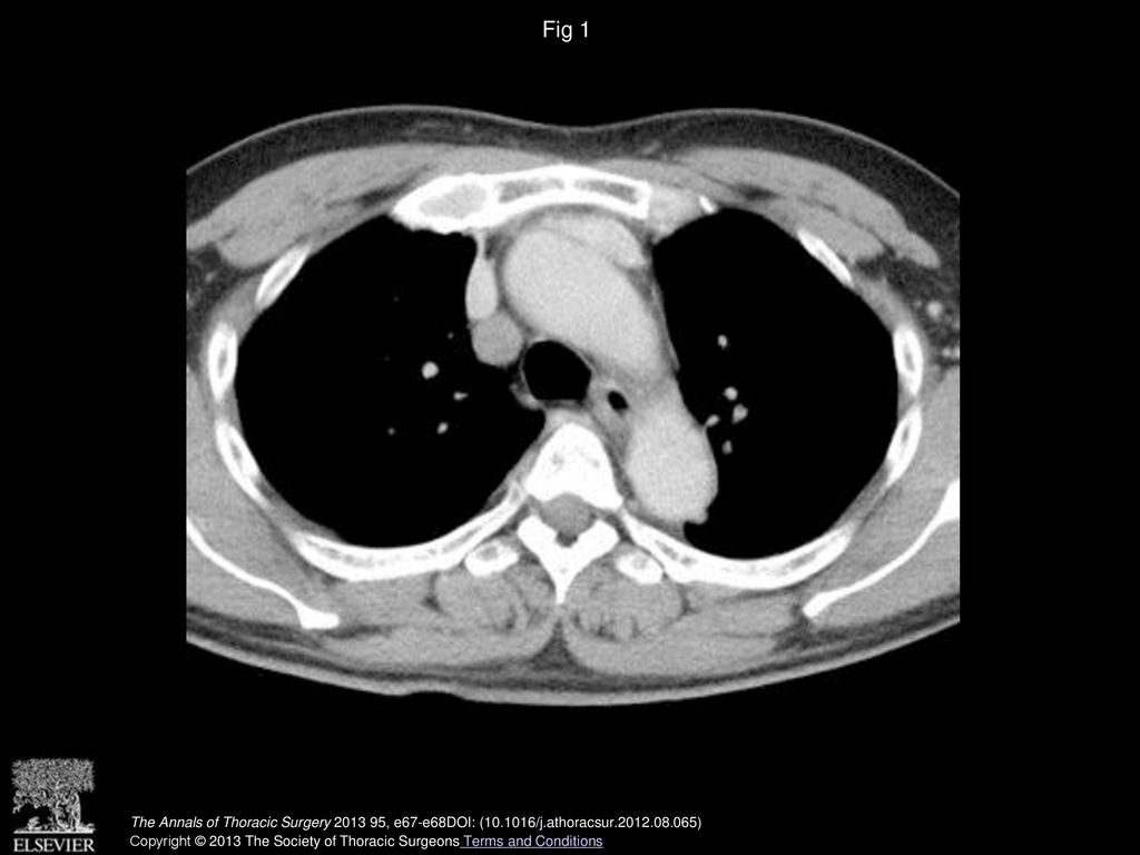 Fig 1 Enhanced computed tomography of the chest showing a solitary and well-defined nodule in the middle mediastinum.