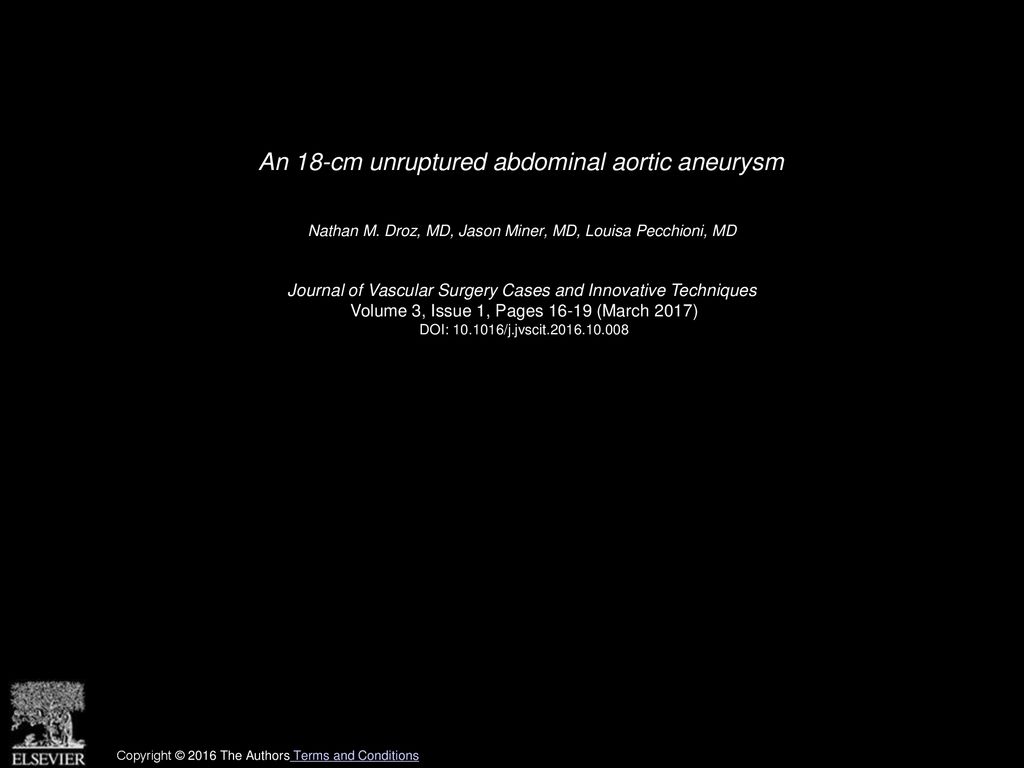 An 18-cm unruptured abdominal aortic aneurysm