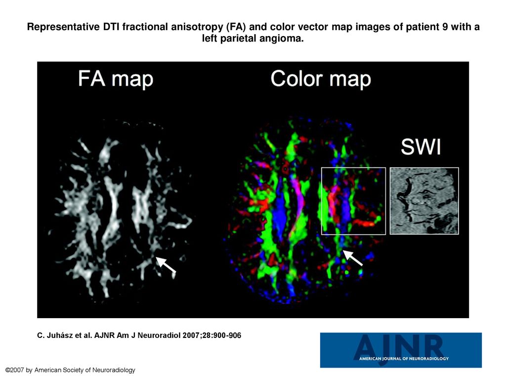 Representative DTI fractional anisotropy (FA) and color vector map images of patient 9 with a left parietal angioma.