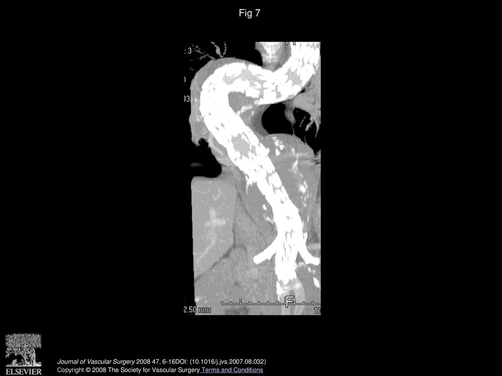 Fig 7 A postoperative computed tomography scan shows a tortuous stent graft within a tortuous aorta.