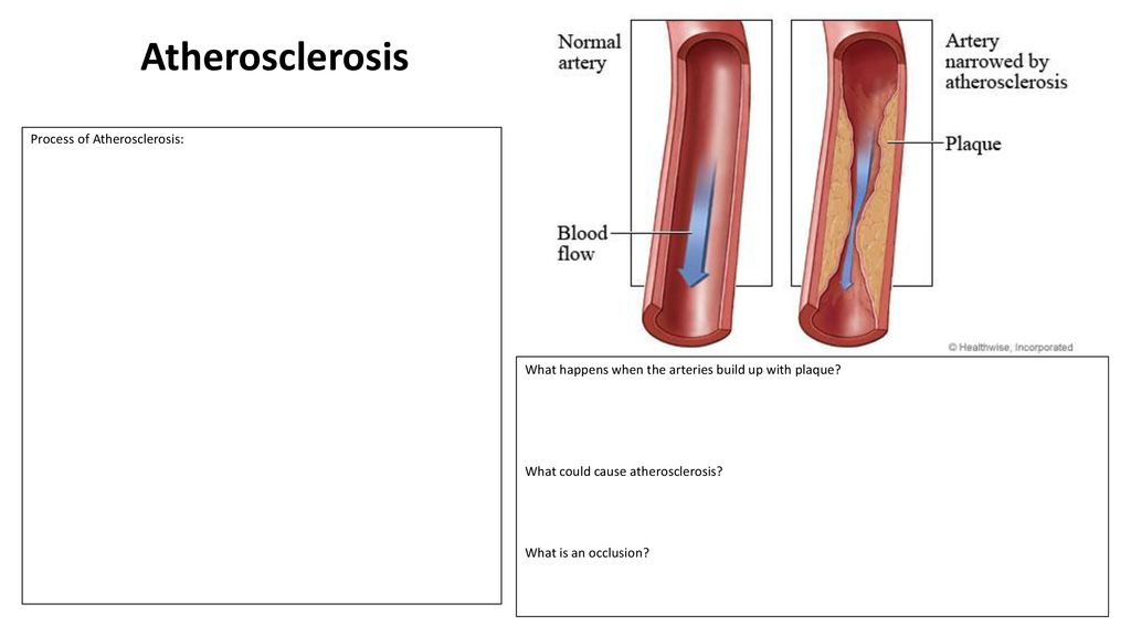 Atherosclerosis Process of Atherosclerosis:
