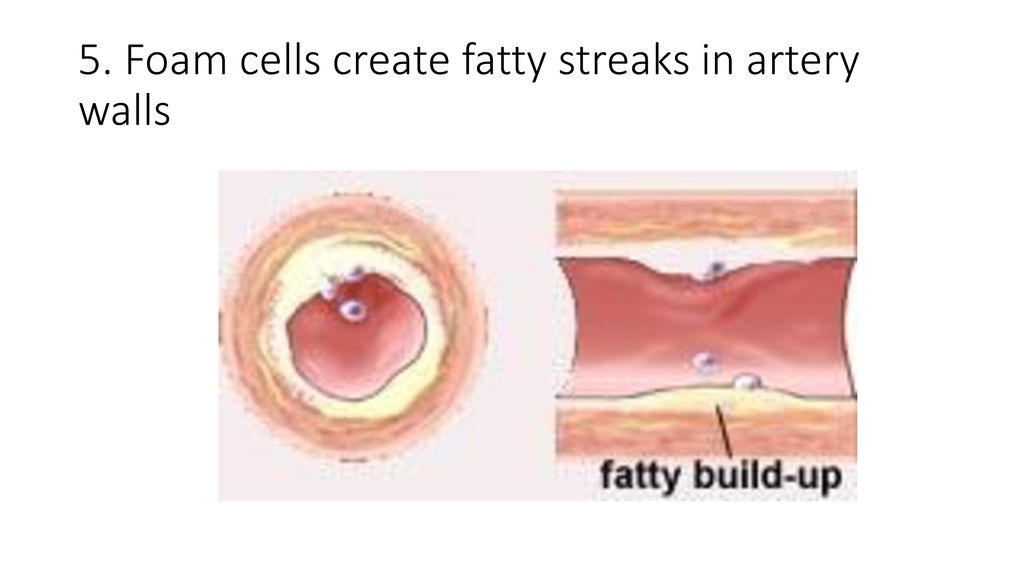5. Foam cells create fatty streaks in artery walls