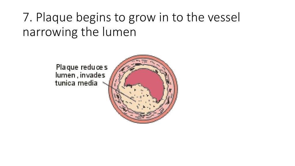 7. Plaque begins to grow in to the vessel narrowing the lumen