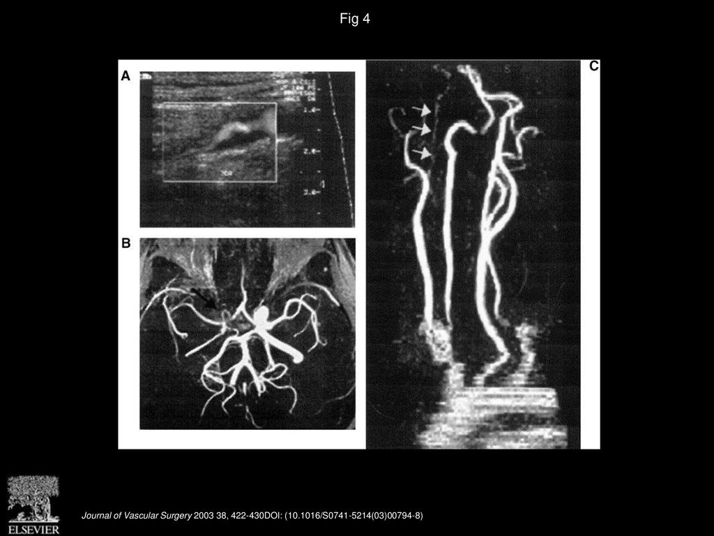 Magnetic resonance angiography minimizes need for arteriography after ...