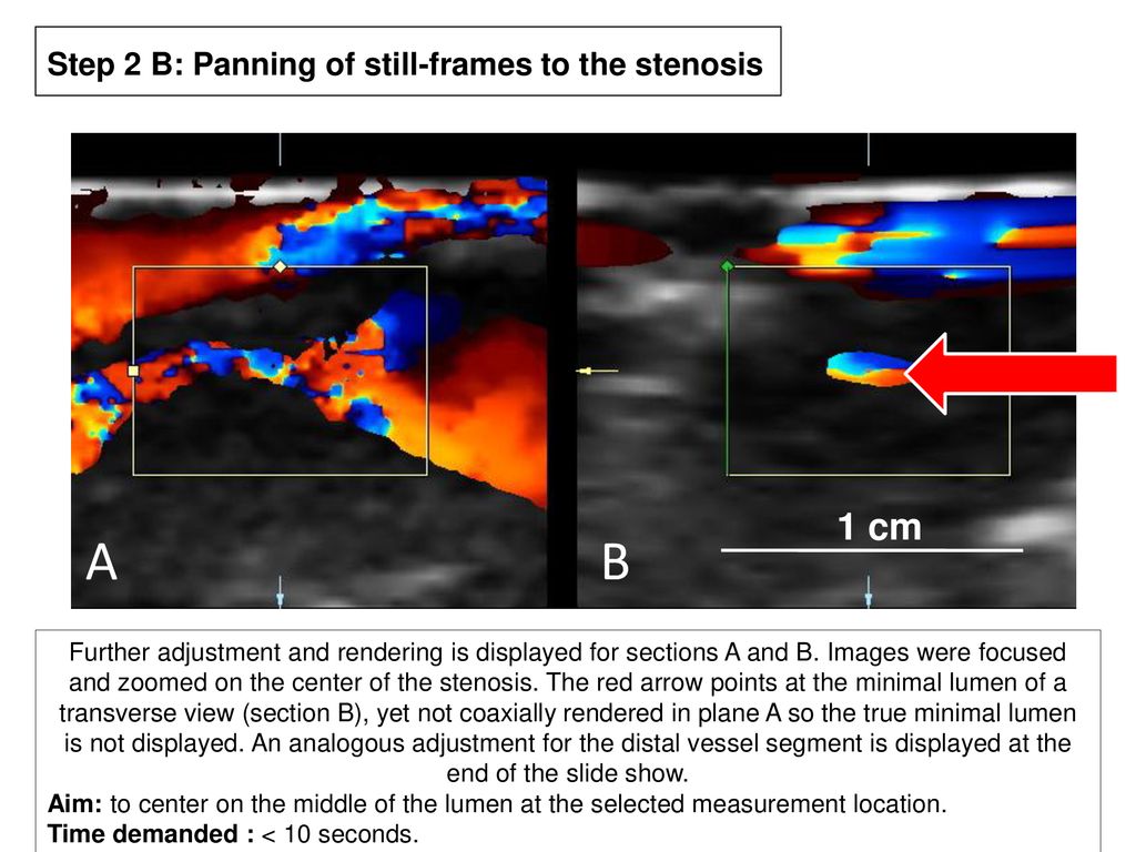 A B 1 cm Step 2 B: Panning of still-frames to the stenosis