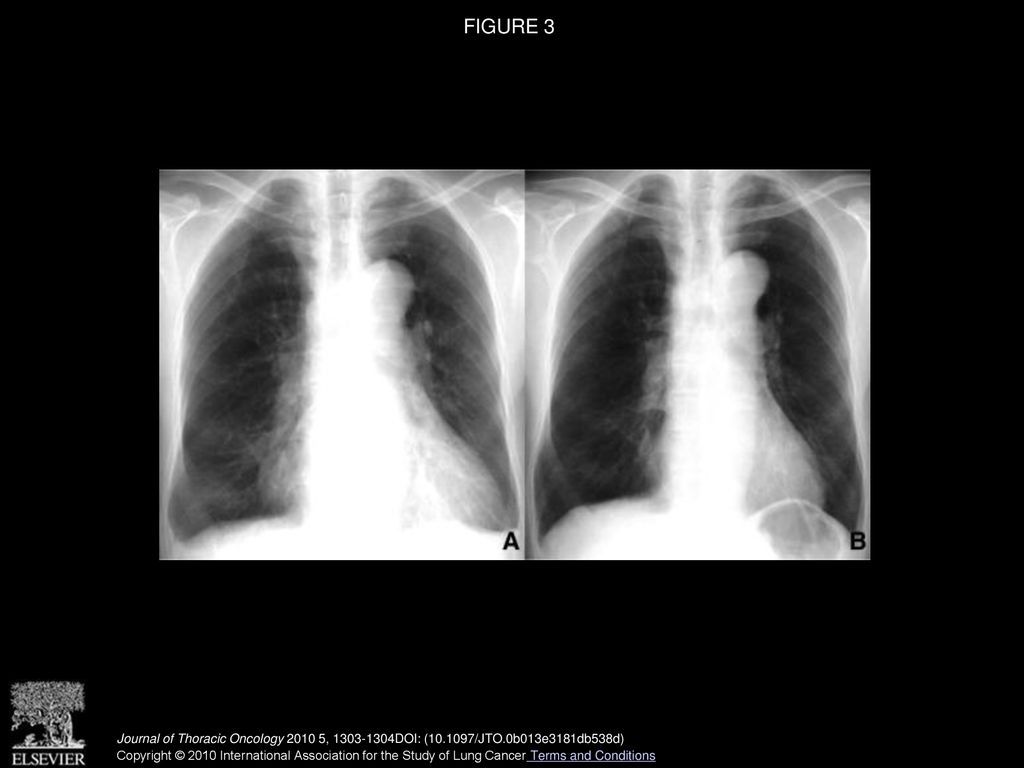 Chylopericardium Caused by Non-small Cell Lung Cancer: A Rare ...