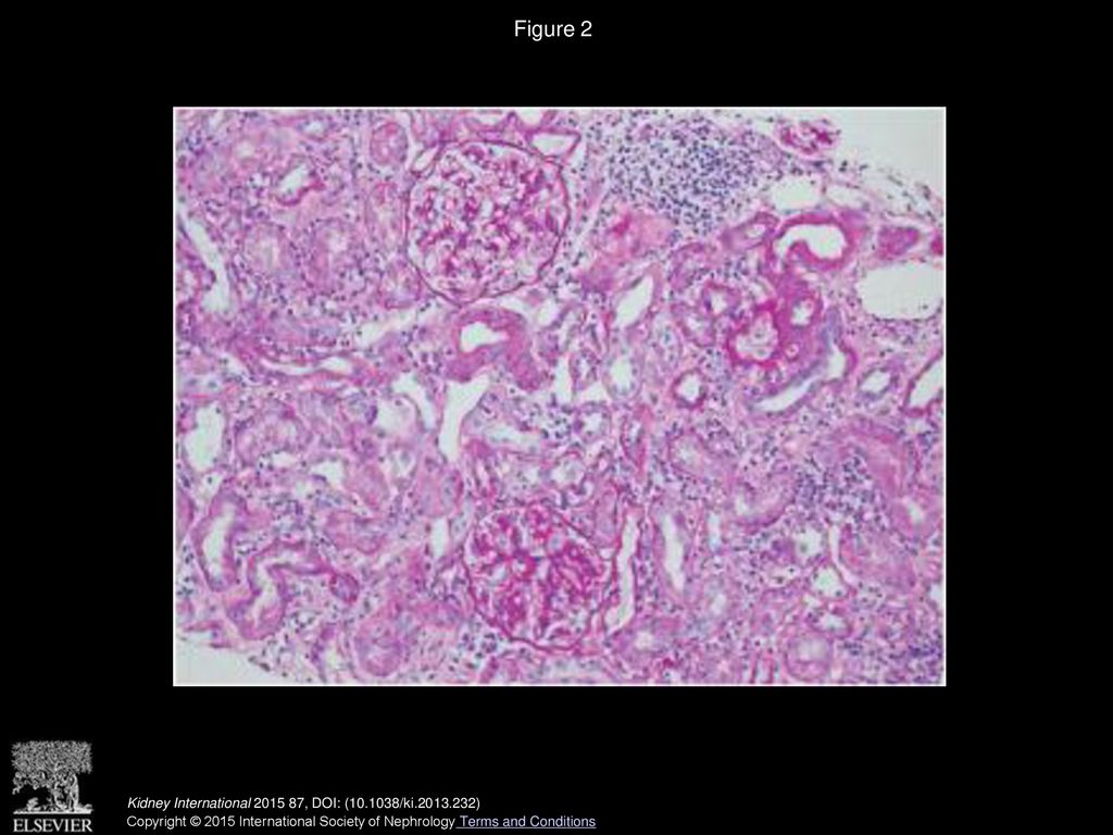 Multiple osteoporotic fractures in a patient with CKD stage G3b - ppt ...