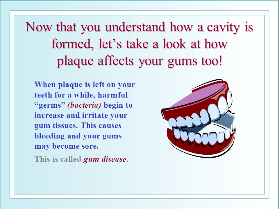 Now that you understand how a cavity is formed, let’s take a look at how plaque affects your gums too!
