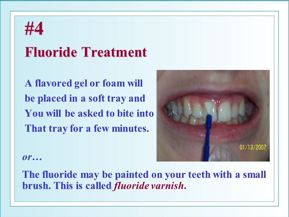 #4 Fluoride Treatment A flavored gel or foam will