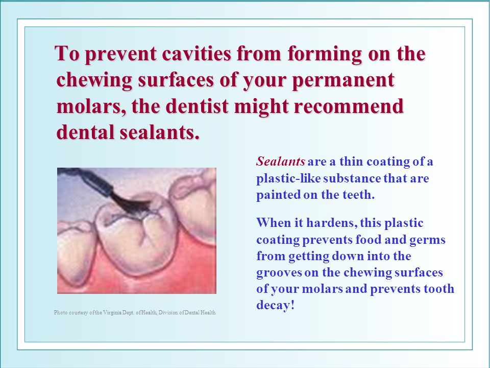 To prevent cavities from forming on the chewing surfaces of your permanent molars, the dentist might recommend dental sealants.