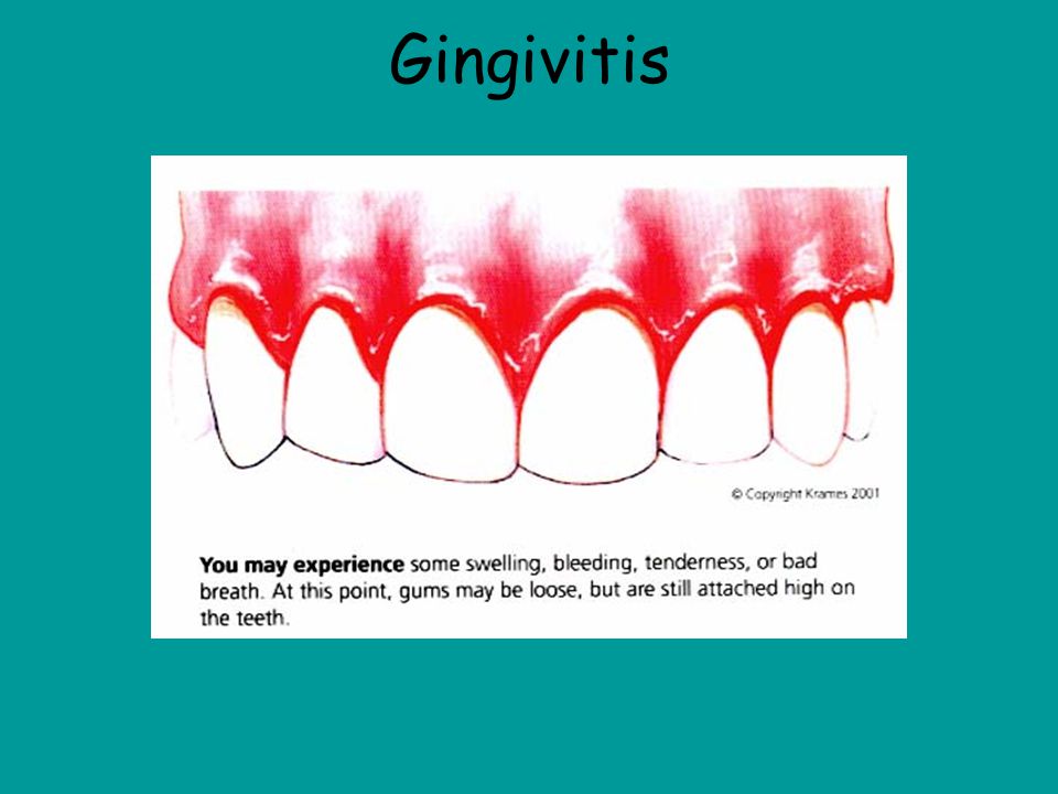 Gingivitis This picture shows a mouth that is infected with gingivitis and you can tell by the redness and the swelling of the gums.