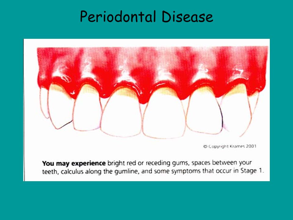 Periodontal Disease This picture shows periodontal disease and you can tell because the gums are receding and the gums are swollen and red.