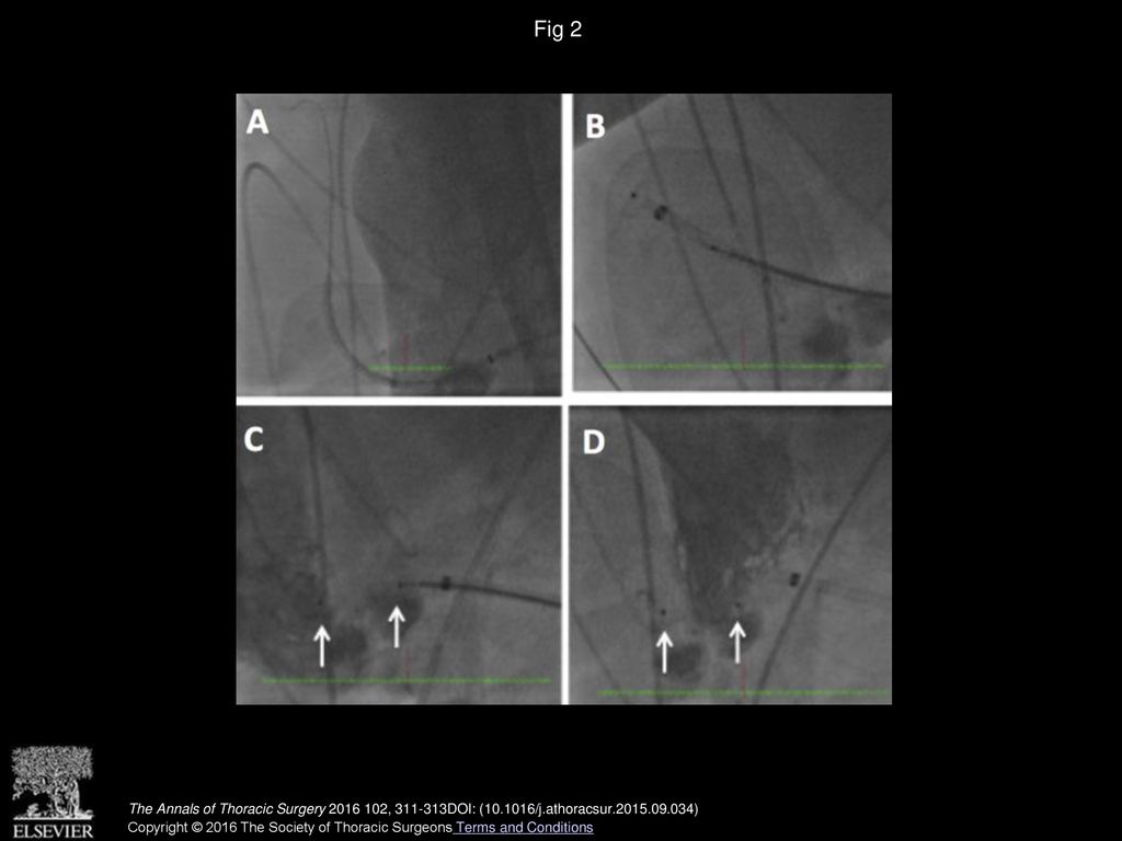 The Parable of the Errant Chest Drain in the Heart: Is There Only 1 ...