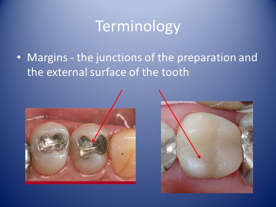 Terminology Margins - the junctions of the preparation and the external surface of the tooth