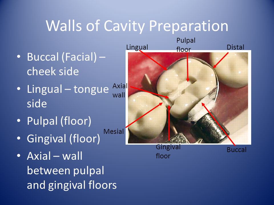 Walls of Cavity Preparation