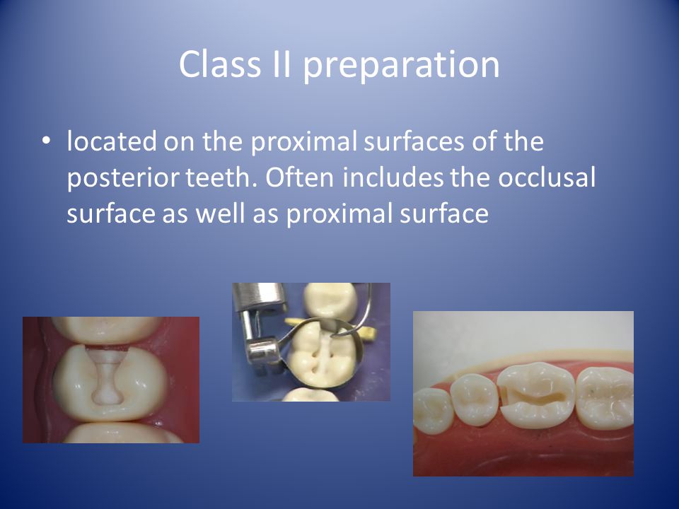 Class II preparation located on the proximal surfaces of the posterior teeth.