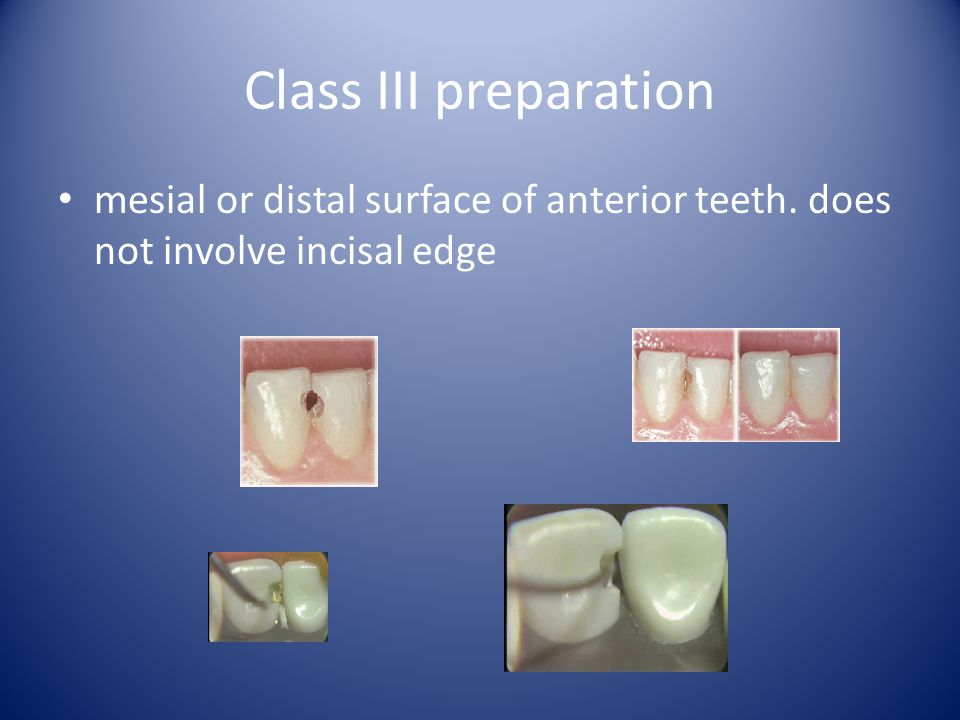 Class III preparation mesial or distal surface of anterior teeth. does not involve incisal edge