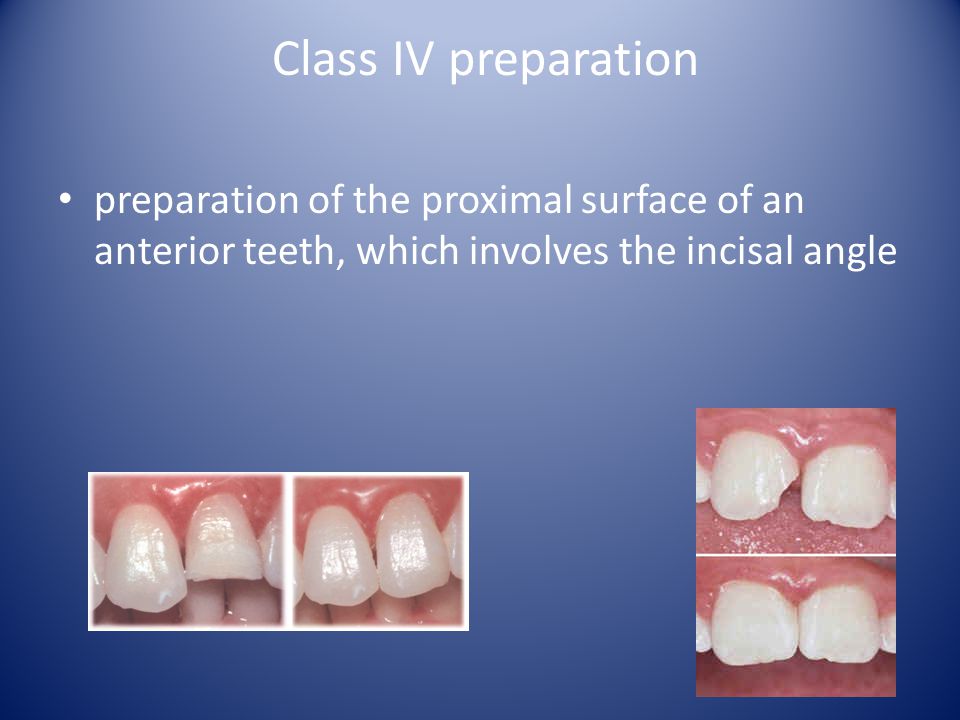 Class IV preparation preparation of the proximal surface of an anterior teeth, which involves the incisal angle.