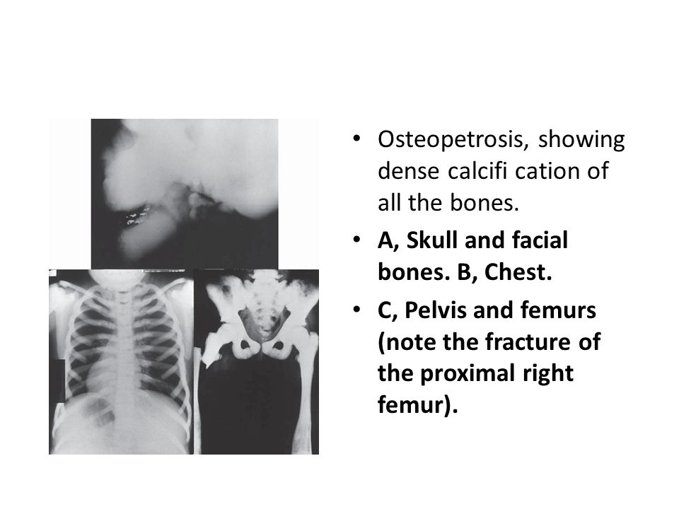 Osteopetrosis, showing dense calcifi cation of all the bones.
