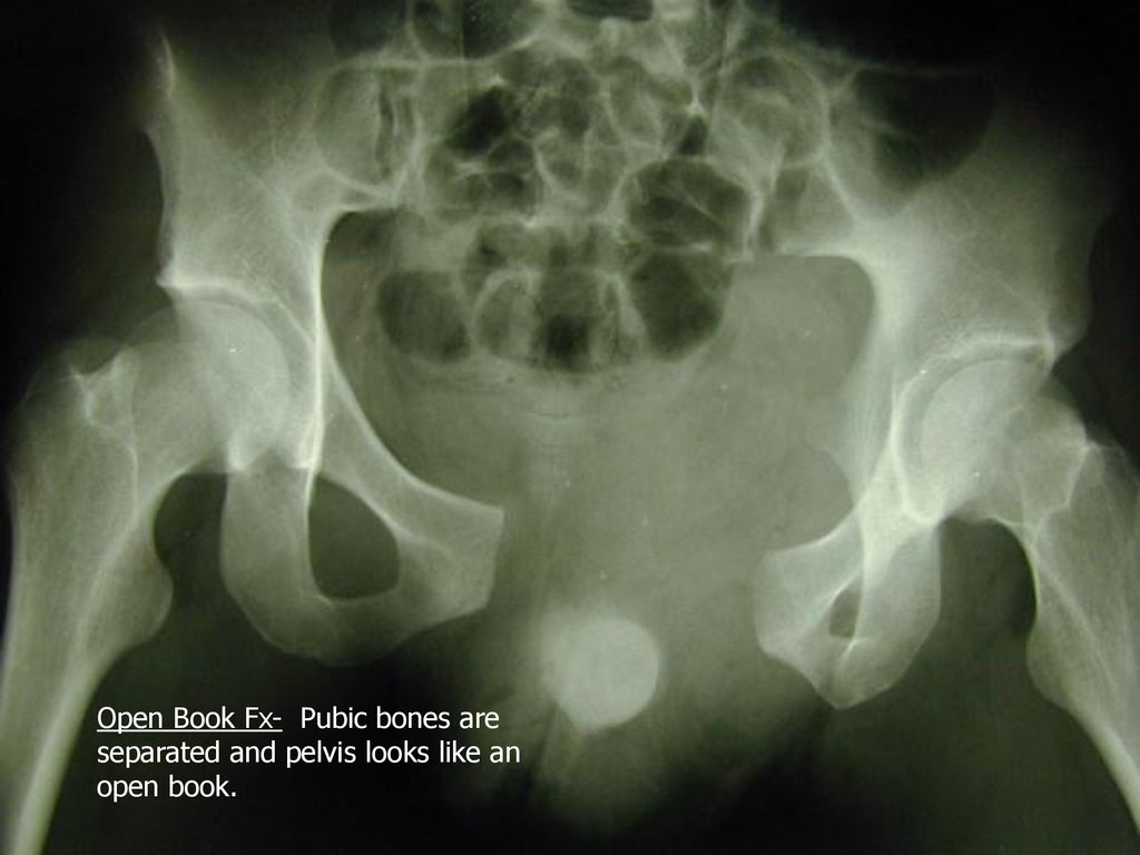 Open Book Fx- Pubic bones are separated and pelvis looks like an open book.
