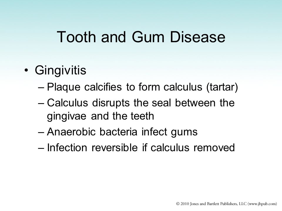 Tooth and Gum Disease Gingivitis