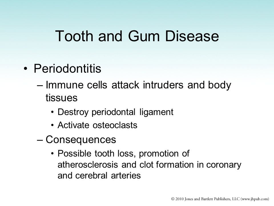 Tooth and Gum Disease Periodontitis