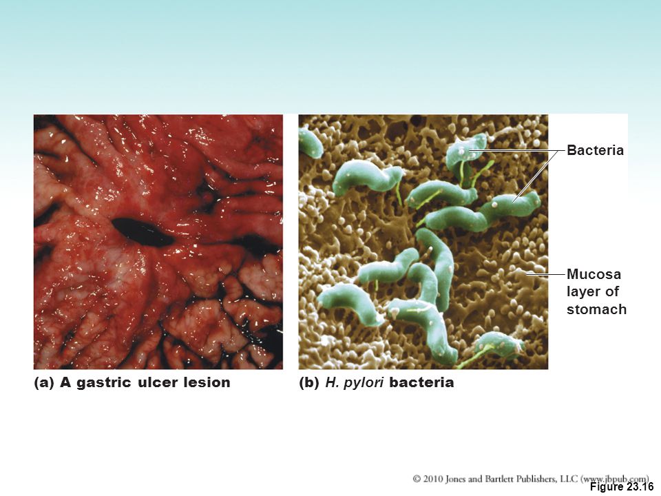 (a) A gastric ulcer lesion (b) H. pylori bacteria