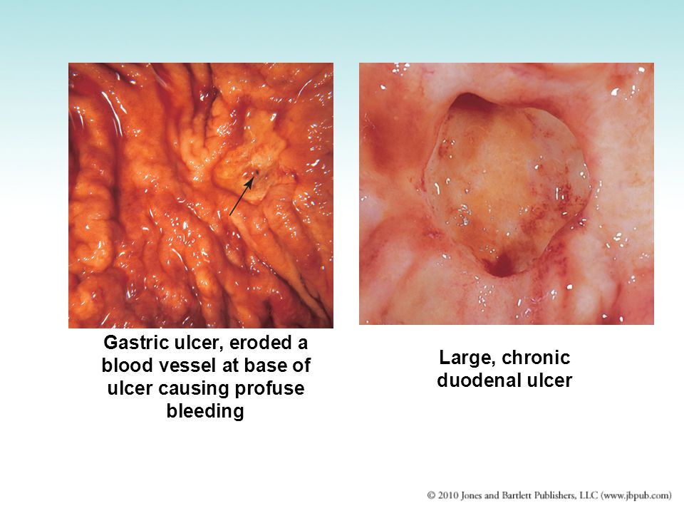 Gastric ulcer, eroded a blood vessel at base of ulcer causing profuse bleeding