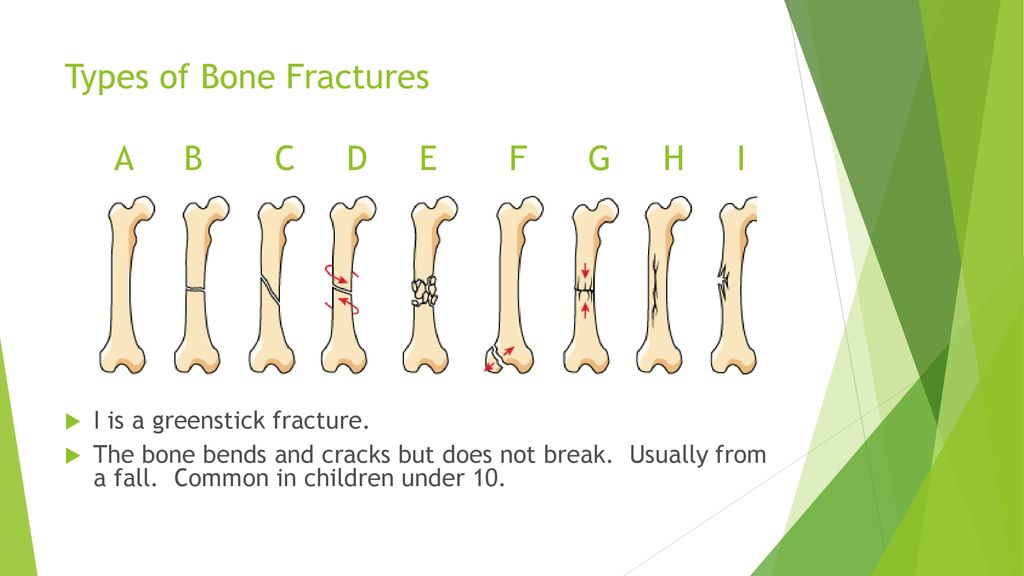Types of Bone Fractures A B C D E F G H I