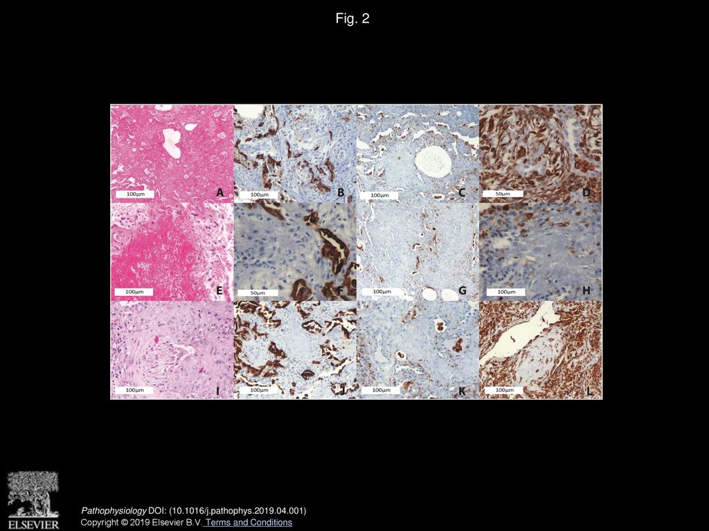 Pathophysiology of acute fibrinous and organizing pneumonia – Clinical ...