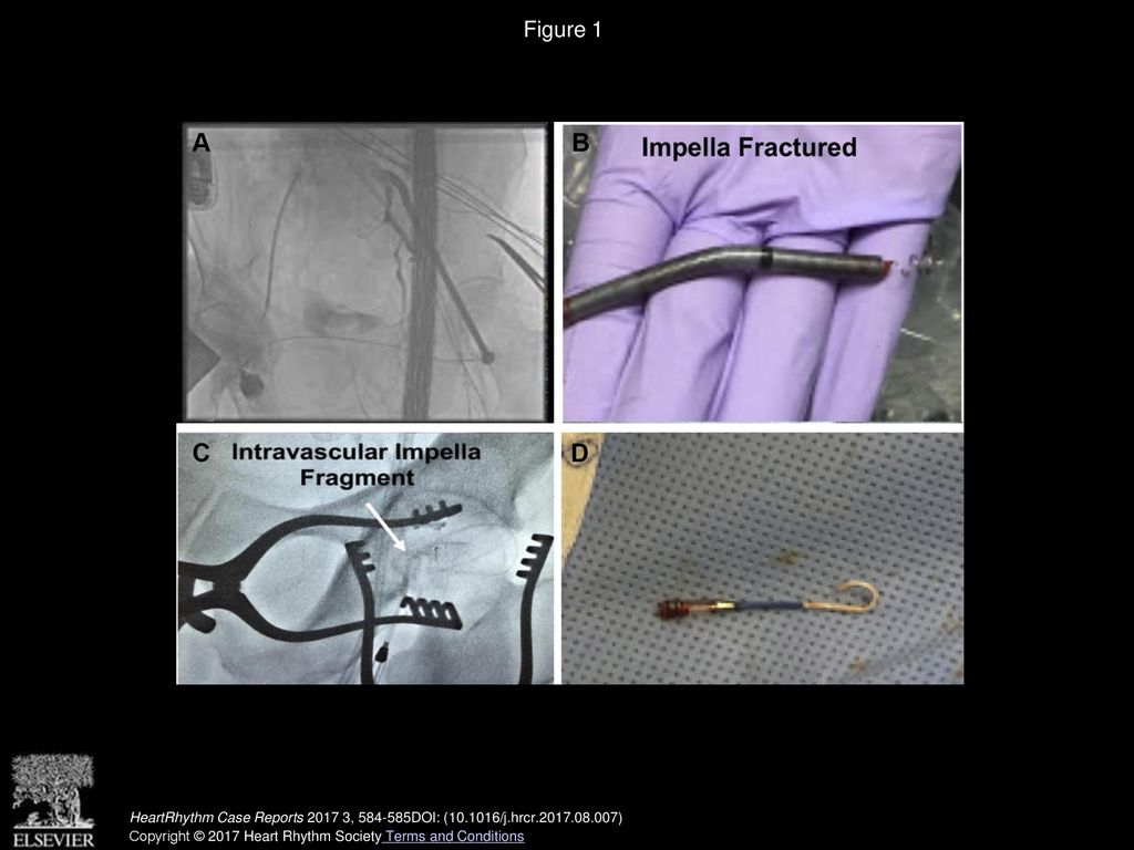 Intravascular fracture of the Impella device during removal - ppt download