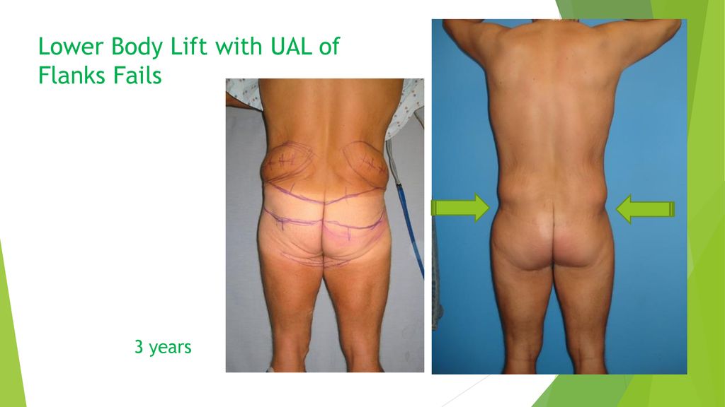 Oblique Flankplasty as an Alternative to Lower Body Lift - ppt download