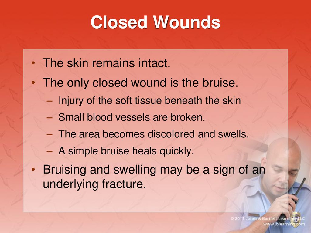 Bleeding, Shock, and Soft-Tissue Injuries - ppt download