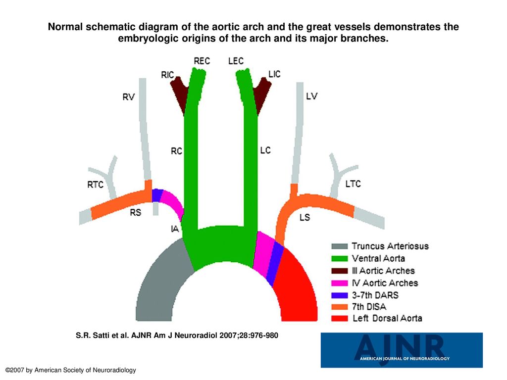 Normal Schematic Diagram Of The Aortic Arch And The Great Vessels