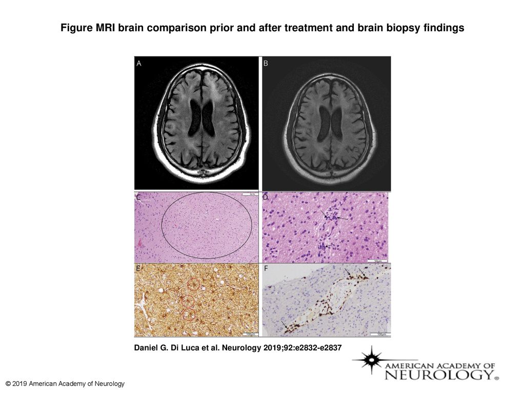 Figure MRI brain comparison prior and after treatment and brain ...