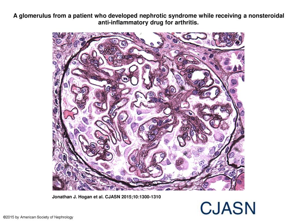 A glomerulus from a patient who developed nephrotic syndrome while receiving a nonsteroidal anti-inflammatory drug for arthritis.