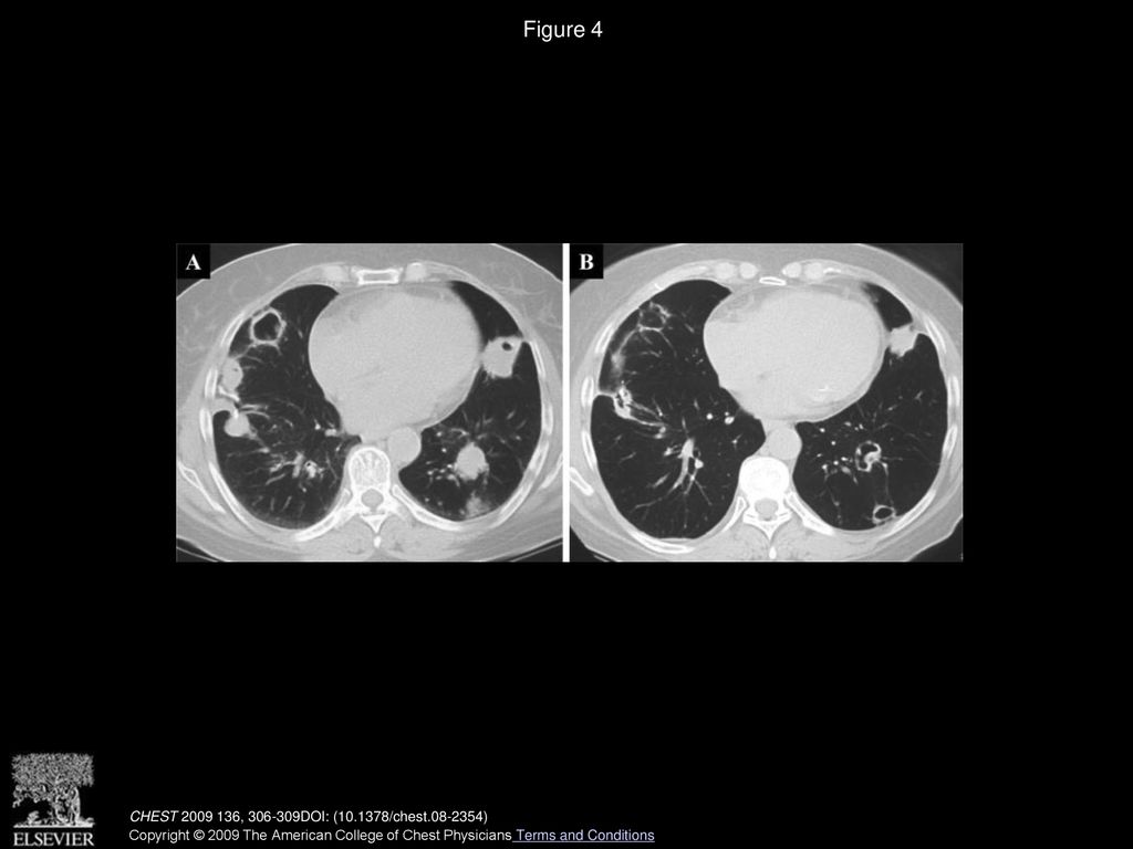 A Rare Cause of Multiple Cavitary Nodules - ppt download