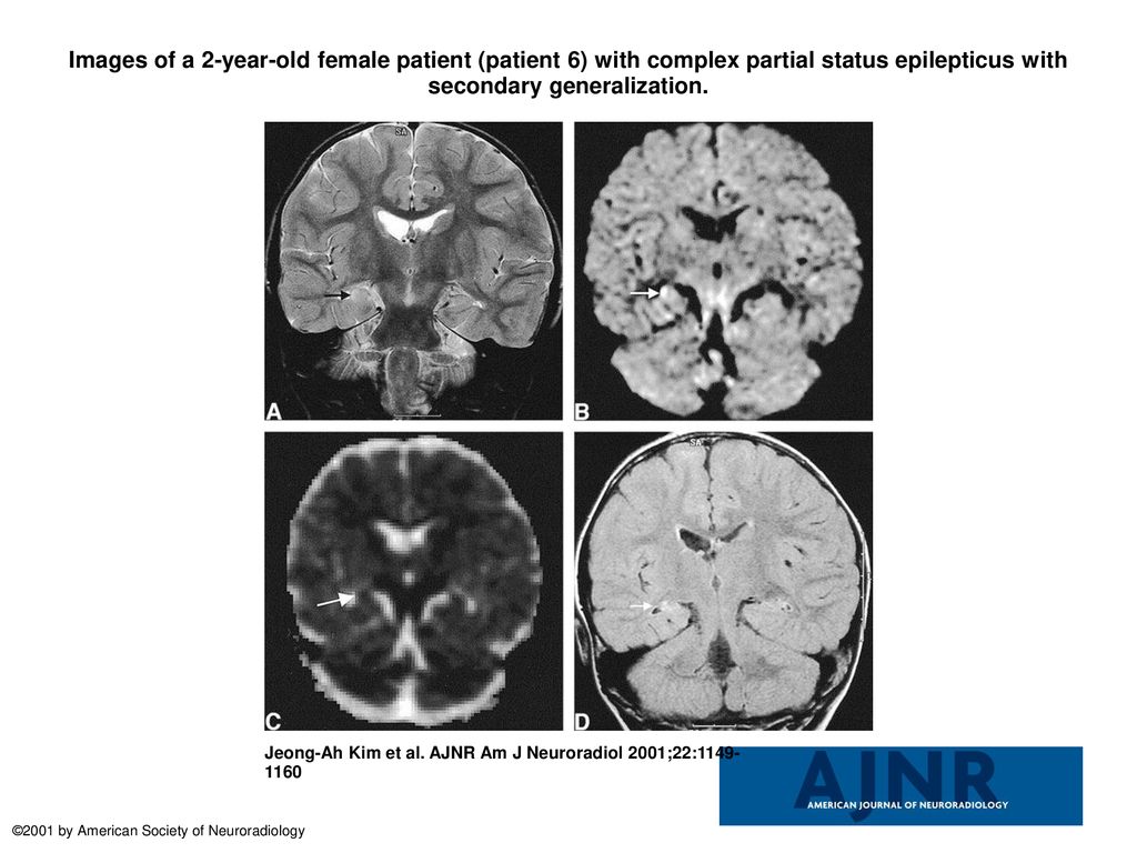 Images of a 2-year-old female patient (patient 6) with complex partial status epilepticus with secondary generalization.