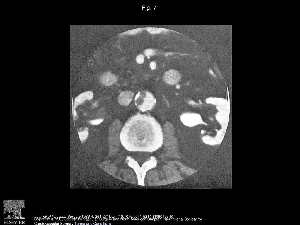 Fig. 7 CT scan shows significant intraluminal thrombus in normal-sized aorta as a source of distal embolization.