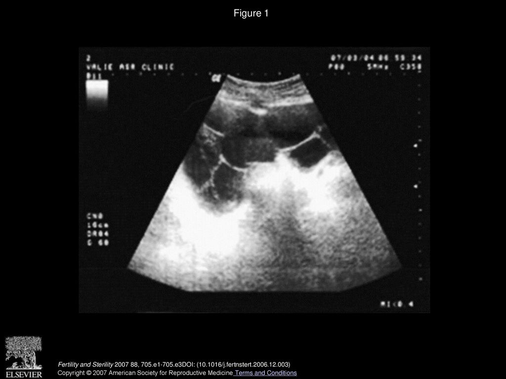 Figure 1 Sonogram showing enlarged ovaries (20 × 16 cm, right ovary, and 16 × 10 cm, left ovary).