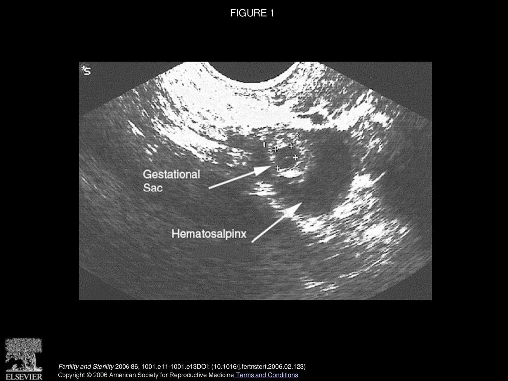 FIGURE 1 Endovaginal ultrasound image showing the gestational sac surrounded by fluid within a hydrosalpinx.