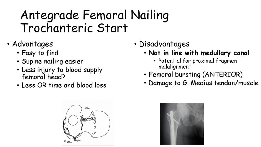 Knee Pain and Functional Outcomes after Retrograde Femoral Nailing: A  Retrospective Review