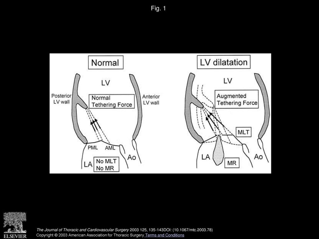 Mechanism of higher incidence of ischemic mitral regurgitation in ...