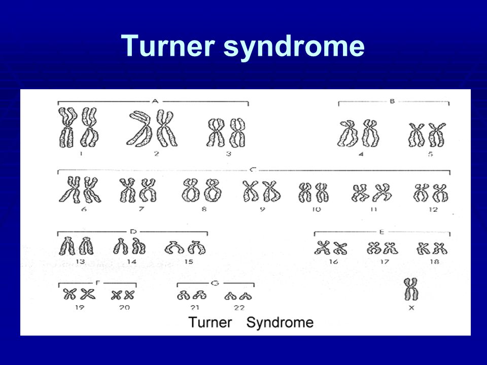 Turner Syndrome Pedigree Chart