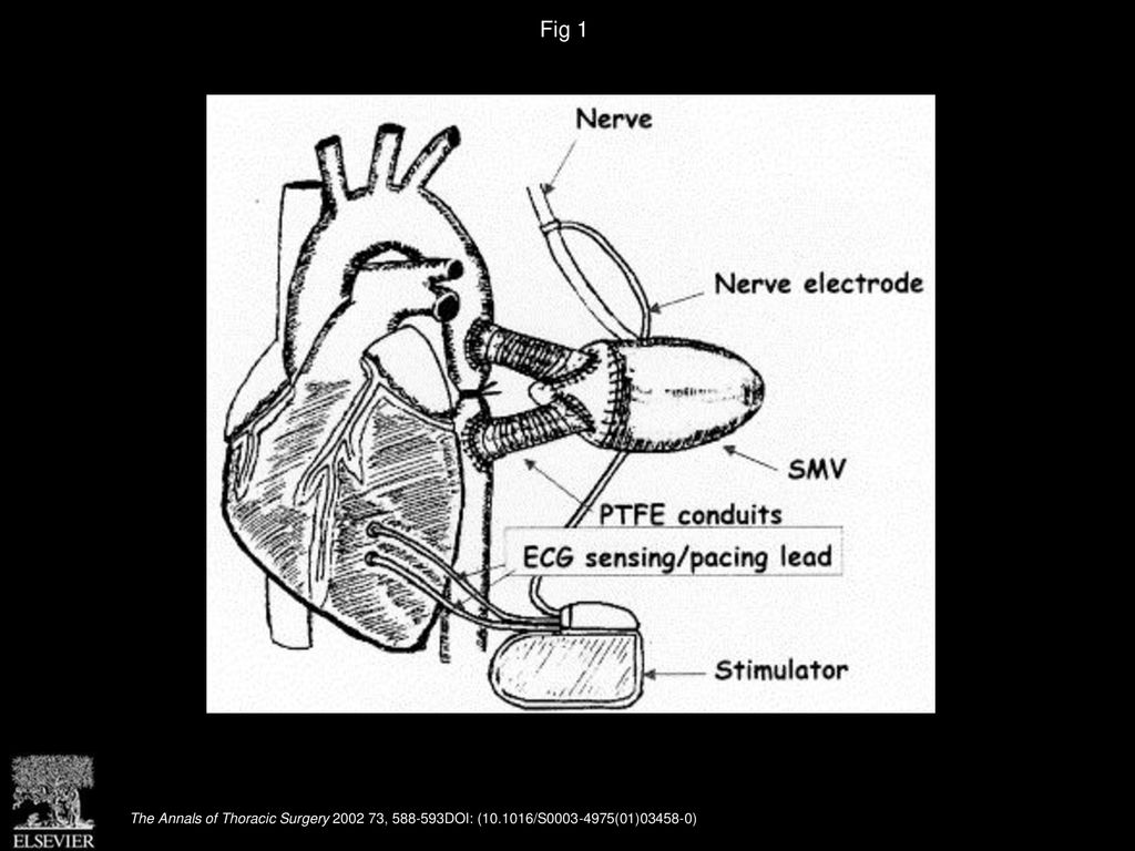 Fig 1 The skeletal muscle ventricle (SMV) aortic counterpulsator model. (ECG = electrocardiogram; PTFE = polytetrafluoroethylene.)