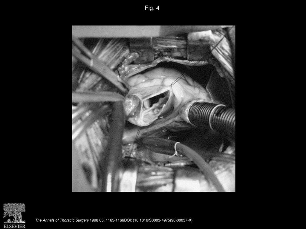 Fig. 4 Access to the aortic valve through the minimally invasive sternotomy.