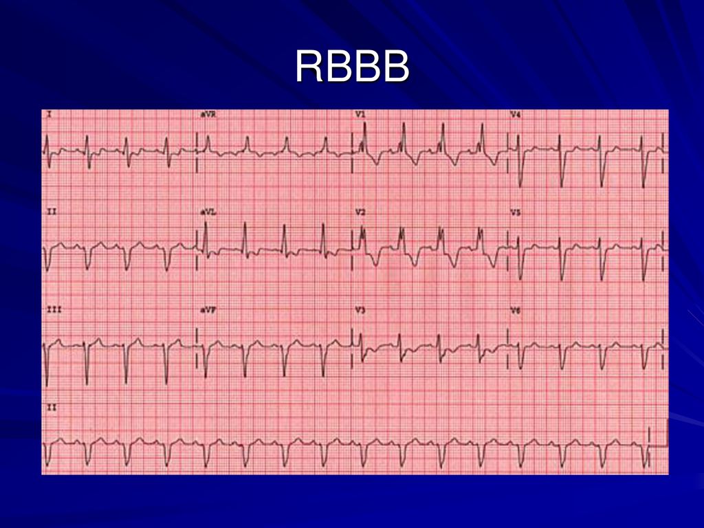 Pediatric EKG Interpretation - ppt download