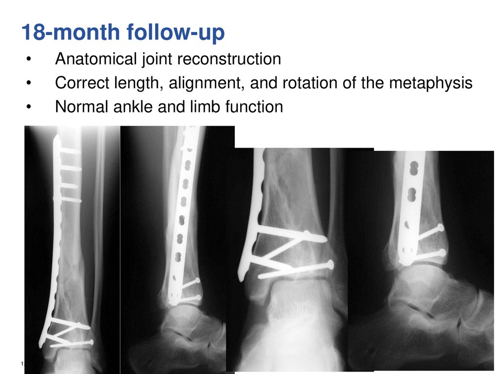 18-month follow-up Anatomical joint reconstruction