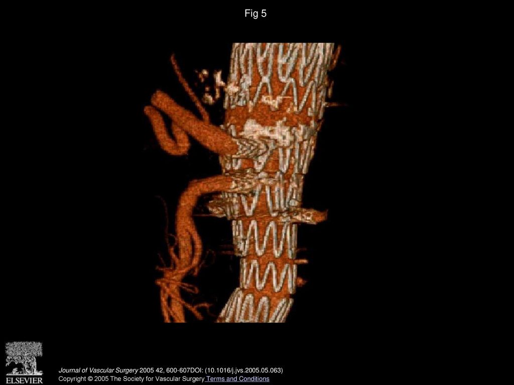 Fig 5 Follow-up computed tomographic angiography in patient 2 demonstrating patent celiac axis, superior mesenteric artery, and both renal arteries.